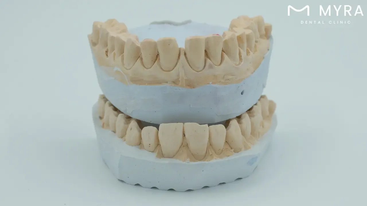 how much are inlays?